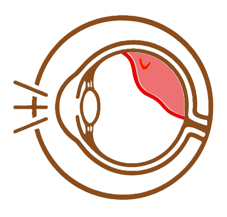 Chirurgie Rétine Kléber